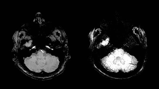 核磁共振上的ct脑部扫描