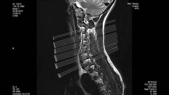 MRI扫描，腰椎，显示尺寸