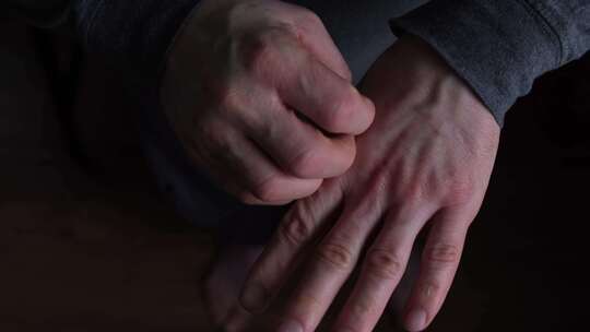 男人的手互相刮伤一种手部皮肤疾病被寄生虫