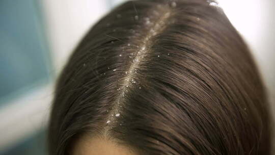 女性头发上的头皮屑视频素材模板下载