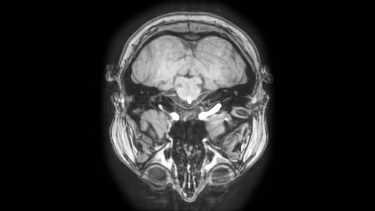 大脑CT扫描