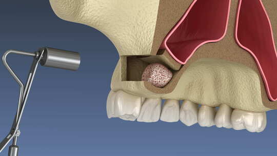 带侧向通道的鼻窦提升手术。牙科手术的3D