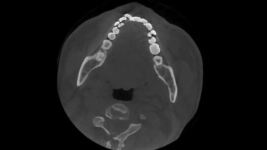 头部CT 牙齿CT 口腔CBCT 轴位成像