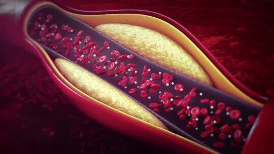 脂肪停留在血液中，动脉胆固醇_4K