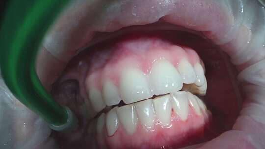 一名牙医在例行牙科检查中为一名妇女刷牙视频素材模板下载