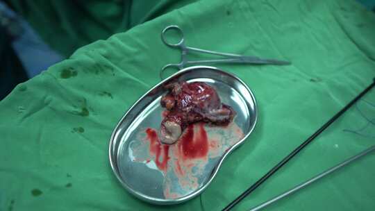 妇科手术（子宫切除）视频素材模板下载