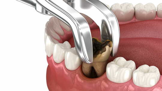 受损牙齿的提取。牙科3D动画