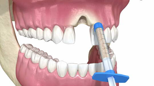 骨移植增高、牙槽保存、牙齿植入