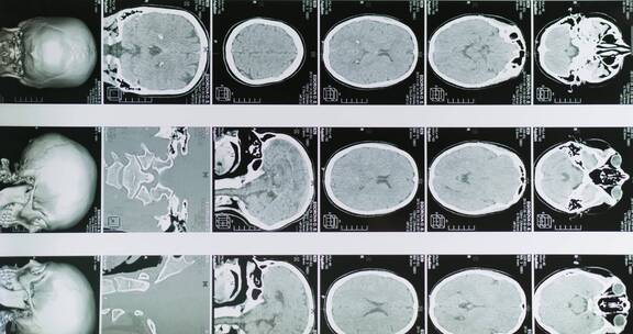 医疗素材头部ct拍片分析结果