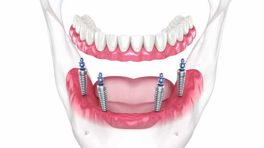 4个植入物支持的假体。牙科3D动画
