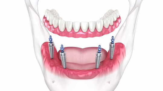 4个植入物支持的假体。牙科3D动画视频素材模板下载