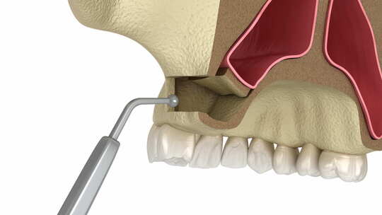 带侧向通道的鼻窦提升手术。牙科手术的3D