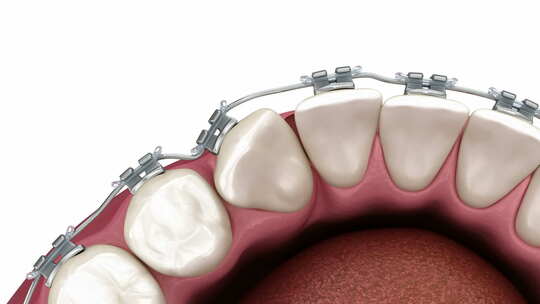 带牙套的丘比特矫正。医学上准确的牙科3D