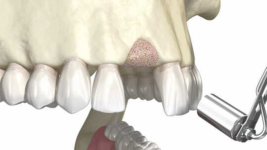 骨移植-使用人造骨和膜增强，牙齿植入