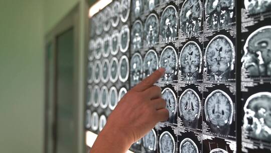 医生诊断 CT  医生给病人诊断   核磁共振视频素材模板下载