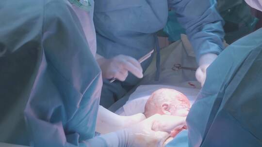 剖腹产手术视频素材模板下载