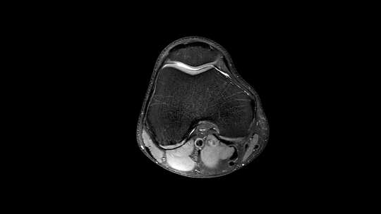 MRI膝关节或磁共振成像检测撕裂或扭伤
