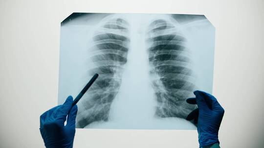 肺部X光检查