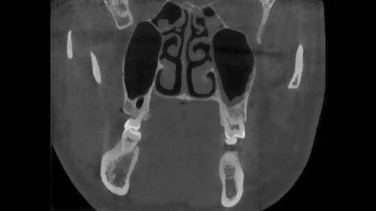 头部CT 冠状位 口腔CBCT