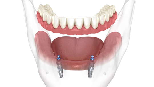 下颌可拆卸假体All on 2系统由带球