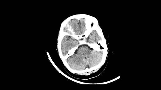 动态头部CT影像 头骨CT影像视频素材模板下载