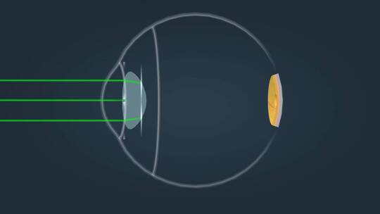 近视眼视力矫正医学人体奥秘三维动画视频素材模板下载