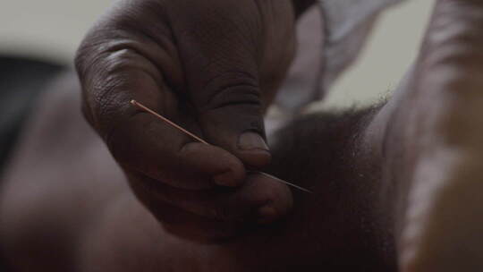 非洲医生在非洲医院给病人做针灸治疗