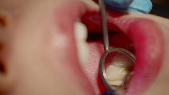 正在牙科诊所洗牙的女生口腔特写视频素材模板下载