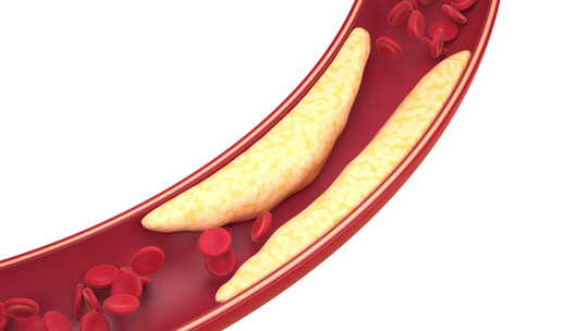 人体血管脂肪堵塞了血管血压流动不顺畅