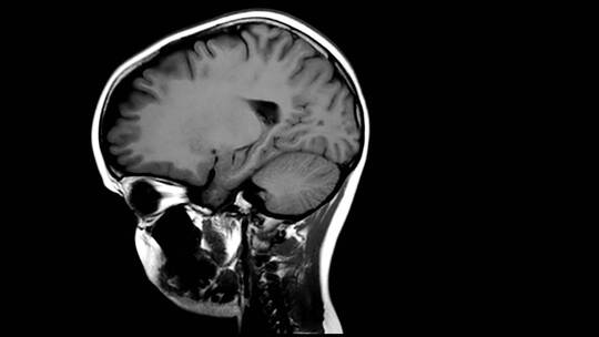 医学 大脑 脑科学 三维 脑ct1 模型