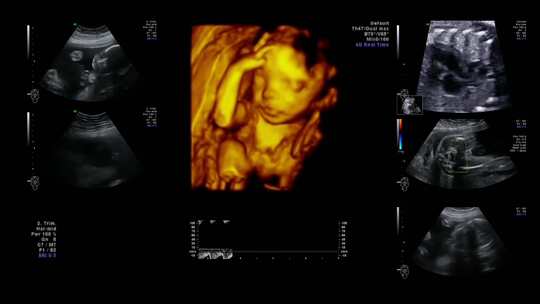 婴儿的超声波图像