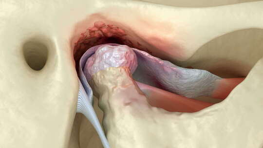 颞下颌关节关节炎和关节盘脱位。牙科3D动视频素材模板下载
