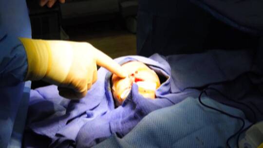 婴儿在陆军医院接受腭裂手术