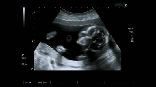 胎儿超声波影像