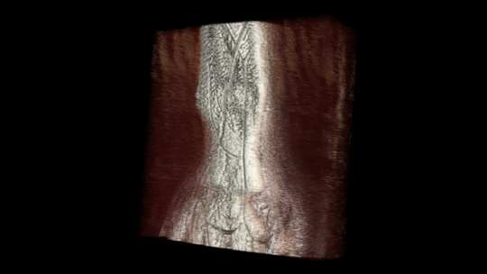 腕部核磁 手腕MRI影像 三维切片 4