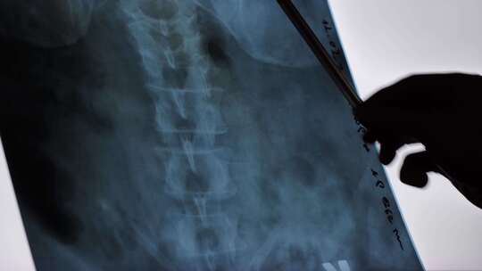 Rengen X线脊柱脊髓特写