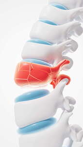 人类脊椎发炎骨裂肿胀治疗动画