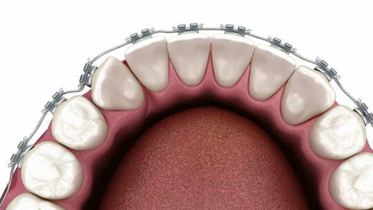 医学口腔牙科牙齿矫正修复3D模拟演示