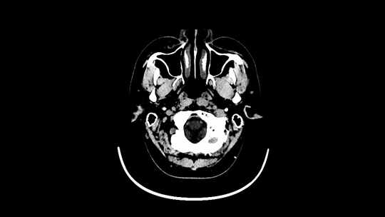 动态头部CT影像 头骨CT影像视频素材模板下载