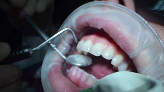 用牙科工具检查和治疗牙齿的人的详细视图电视频素材模板下载