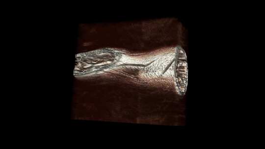 腕部核磁 手腕MRI影像 三维切片 10