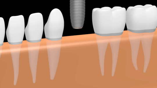 牙齿修复牙科医学动画视频素材模板下载