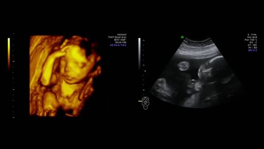 婴儿在母体里活动超声波影像视频素材模板下载