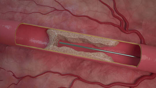 超声波血栓血管钙化血栓去除冠状动脉钙化