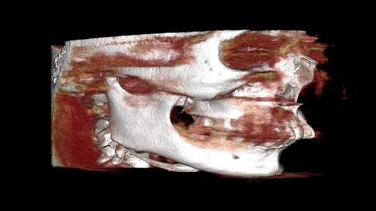 口腔CBCT 冠状位 头部3D 牙齿CT