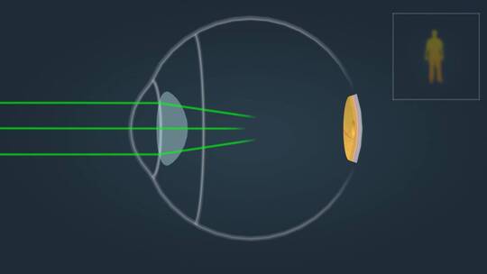 近视眼视力矫正