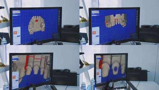 带3d义齿扫描的电脑屏幕。门牙植入的准备高清在线视频素材下载