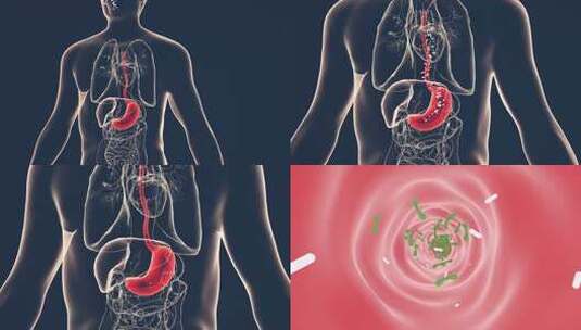 胃酸反流食管高清在线视频素材下载