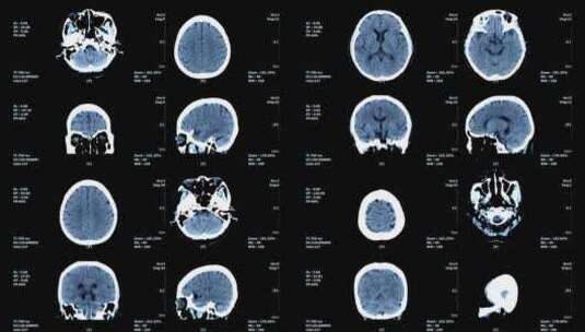 脑部CT影像高清在线视频素材下载