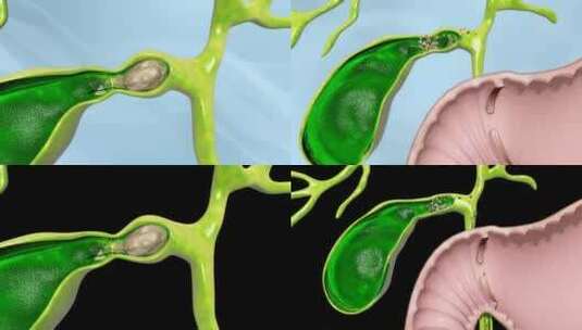 胆囊结石 胆囊息肉 胆囊病变 胆管结石高清在线视频素材下载